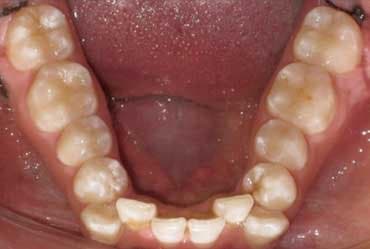 Antes - Ortodoncia – Arco Inferior