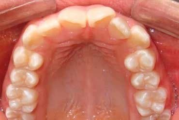 Antes - Ortodoncia Lingual