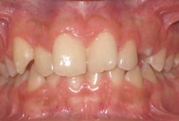 Antes - Ortodoncia