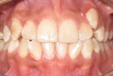 Antes - Ortodoncia