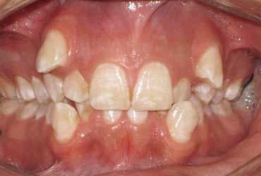 Antes - Ortodoncia – Caso Severo