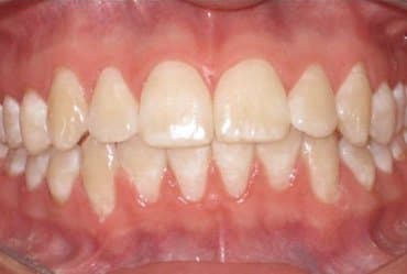 Después - Ortodoncia