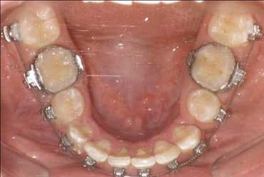 Después - Ortodoncia – Arco Inferior