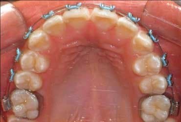 Después - Ortodoncia Lingual